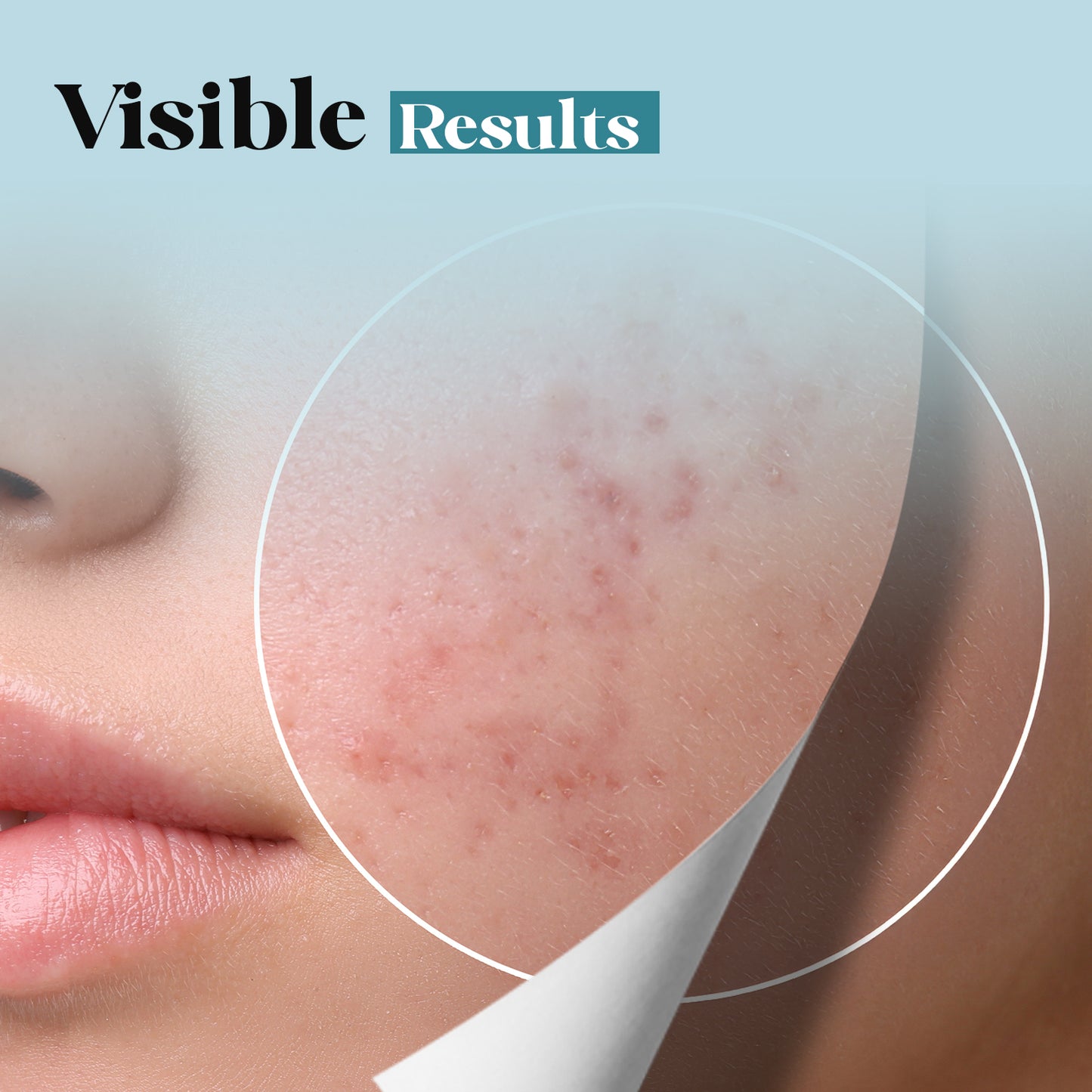 Just Awe 5 In-1 Acne Face Moisturizer - 50gm